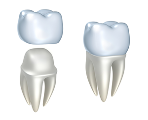illustration showing how dental crown fits over tooth, Windsor Locks, CT crowns